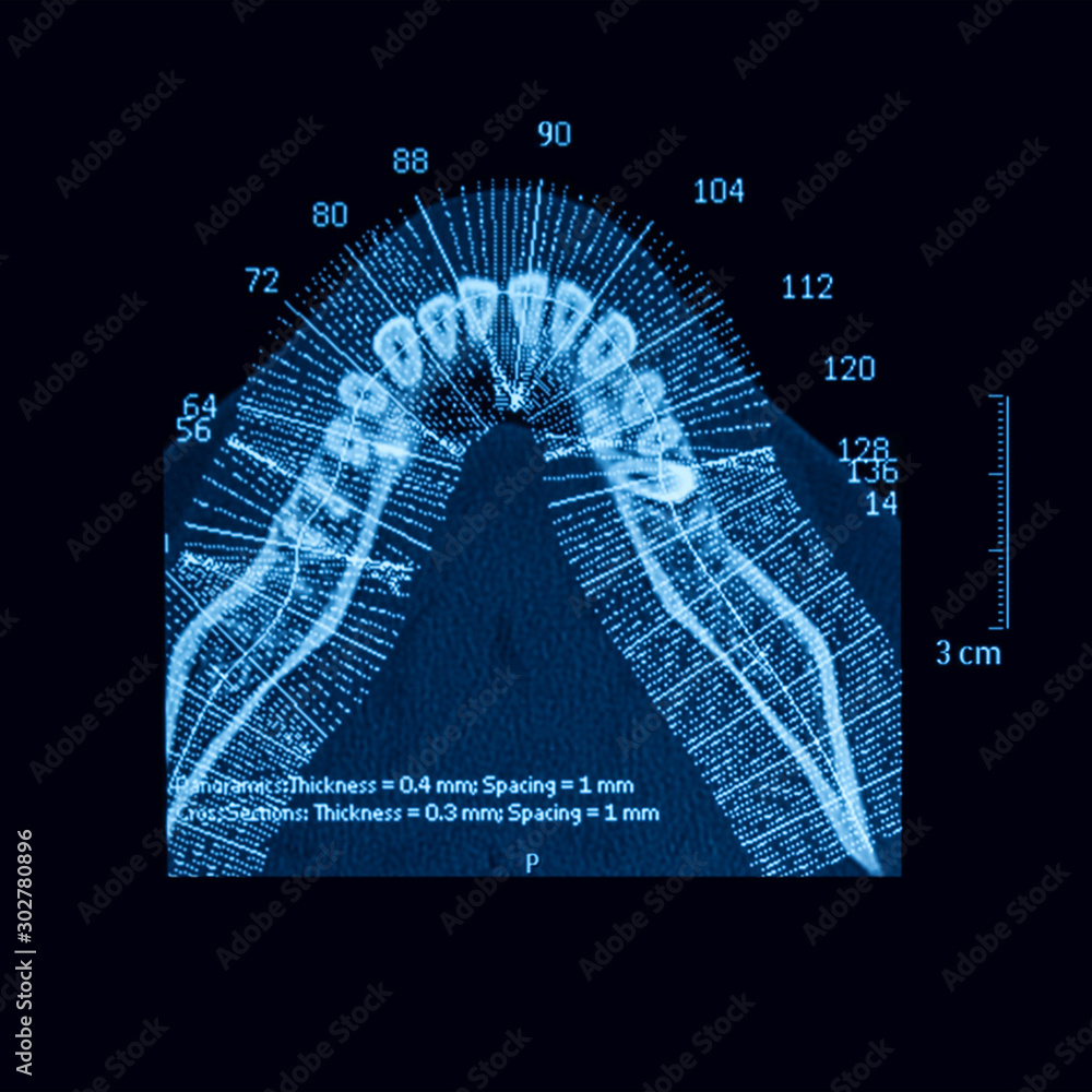 Foto de Computed tomography (CT-scan) of mandibular teet do Stock ...