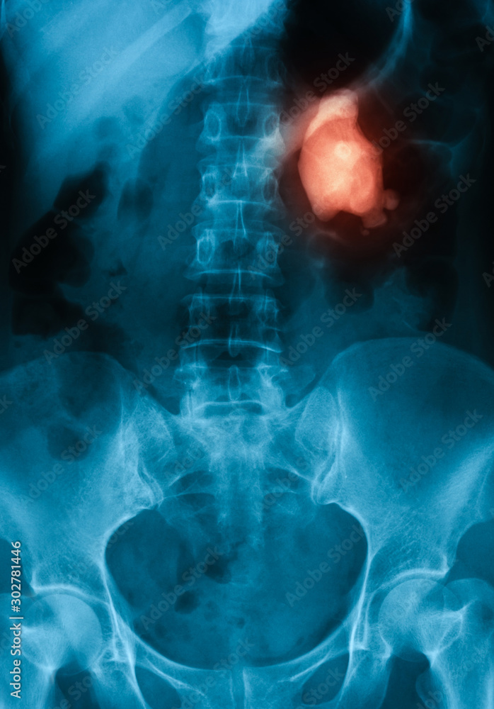 X Ray Image Of Urinary Tract Kedny Urenary And Bladder Kub Showing