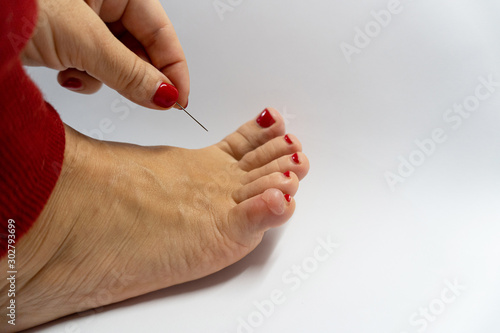 Huge water foot corn on a pinky toe at woman led and womans hand with a needle, close up of a callus, isolated on white background. Cosmetology concept. photo