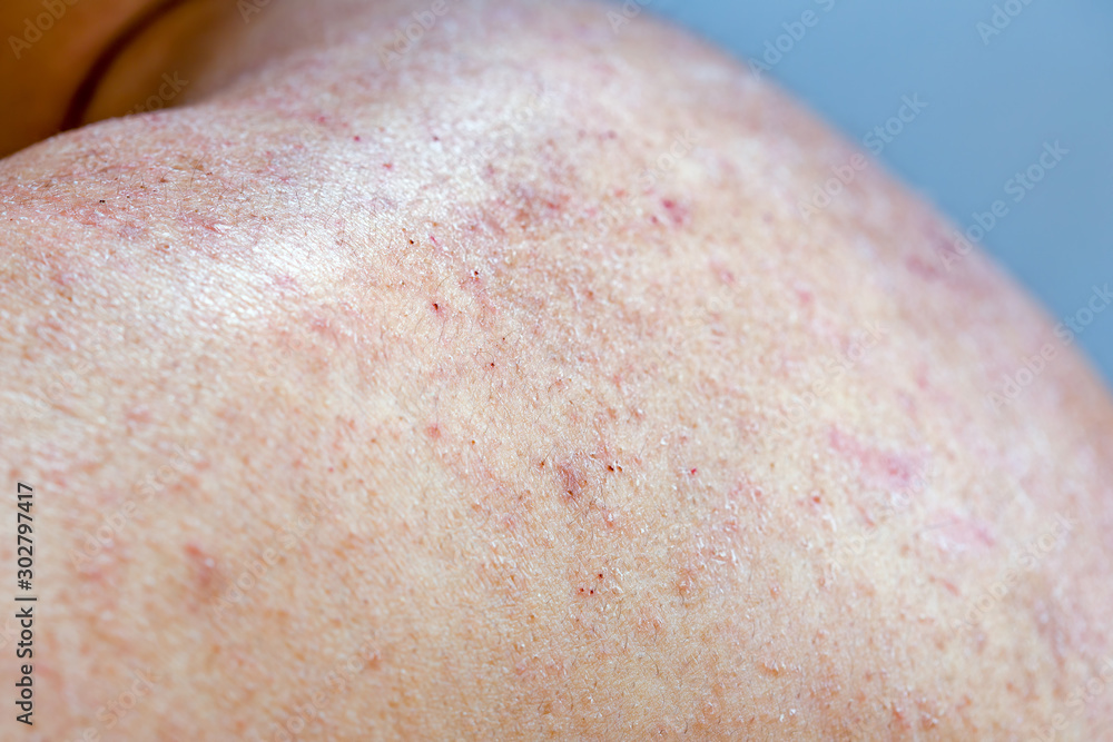 Fototapeta premium Extreme close-up photography of the atocpic dermatitis symptoms on the left shoulder of an adult male.