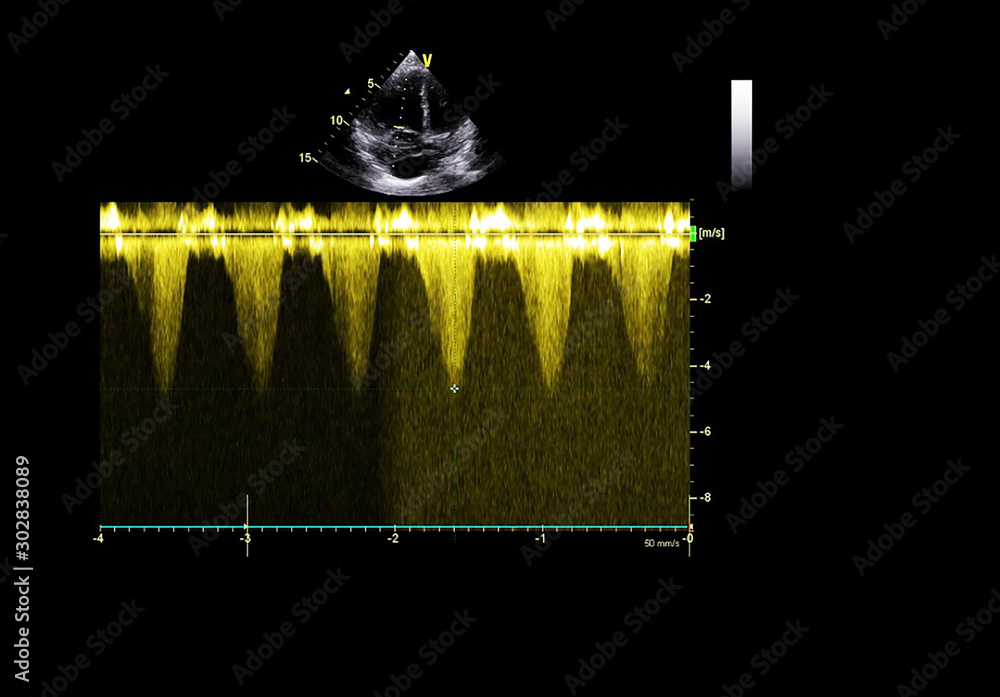 Screen of echocardiography (ultrasound) machine. Stock Photo | Adobe Stock