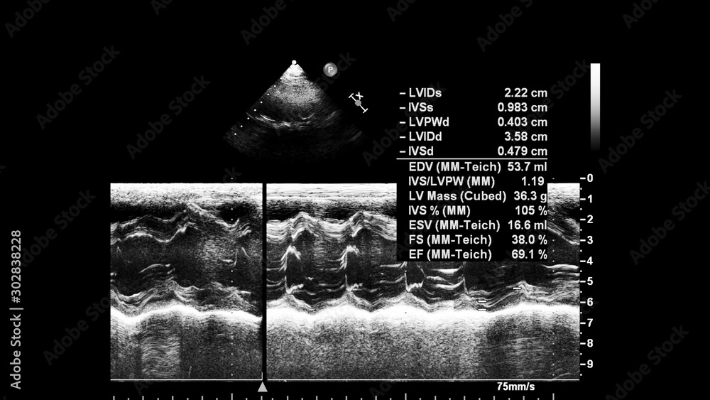 Fototapeta premium Screen of echocardiography (ultrasound) machine.