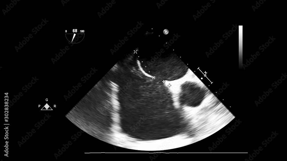 Screen of echocardiography (ultrasound) machine. Stock Photo | Adobe Stock