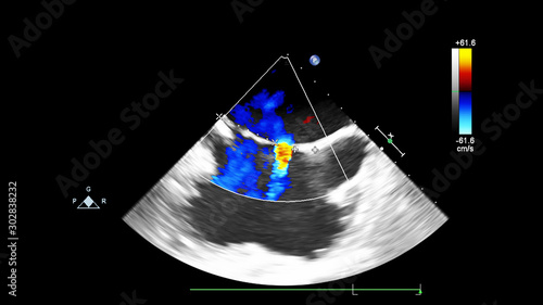 Screen of echocardiography (ultrasound) machine.