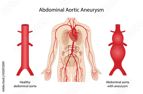 Abdominal aortic aneurysm. Arterial circulatory system of the abdominal. Healthy abdominal aorta and abdominal aorta with aneurysm. Vector illustration in flat style isolated on white background photo