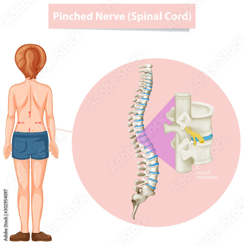 Diagram showing pinched nerve