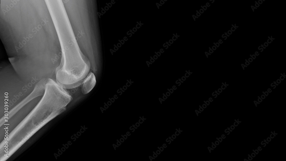 Film X-ray knee radiograph show Fibrous dysplasia(FD) disease which benign tumor of bone (osteolytic bone neoplasm). The young patient has pain and weak bone problem. Medical oncology concept Film X-ray knee radiograph show Fibrous dysplasia(FD) disease which benign tumor of bone (osteolytic bone neoplasm). The young patient has pain and weak bone problem. Medical oncology concept