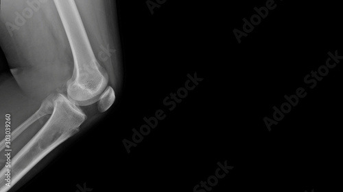Film X-ray knee radiograph show Fibrous dysplasia(FD) disease which benign tumor of bone (osteolytic bone neoplasm). The young patient has pain and weak bone problem. Medical oncology concept
