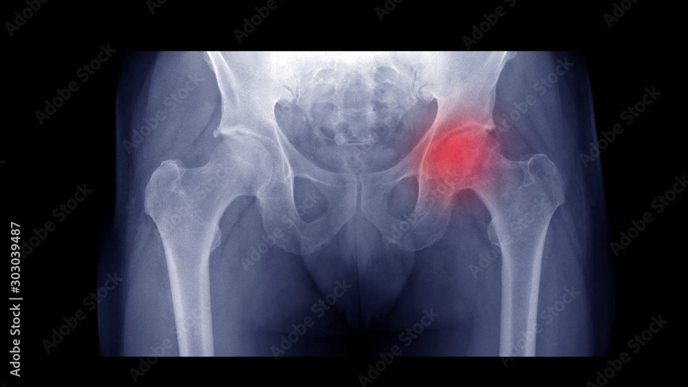 Φωτογραφία Film X-ray hip radiograph show Left femoral head collapse form Avascular necrosis (AVN) or Osteonecrosis (ON) disease
