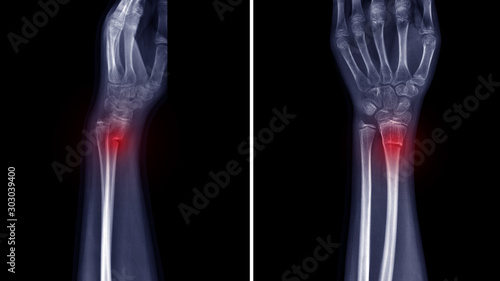 Film X-ray wrist radiograph show lower end of forearm bone broken (torus or buckle fracture) from traffic accident. Highlight on broken site and painful area.  Medical imaging and technology concept photo