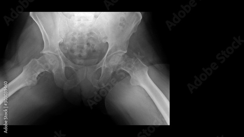 Film X ray hip radiograph show femoral head collapse form bone infarction or avascular necrosis (AVN) or Osteonecrosis (ON) disease with progressive arthritis joint. Medical diagnosis concept. photo