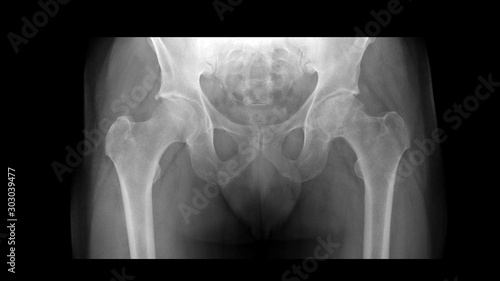 Film X ray radiograph show Left femoral head collapse form infarction or avascular necrosis(AVN) or Osteonecrosis(ON) disease and Right hip show osteoarthritis disorder(OA). Medical radiology concept. photo