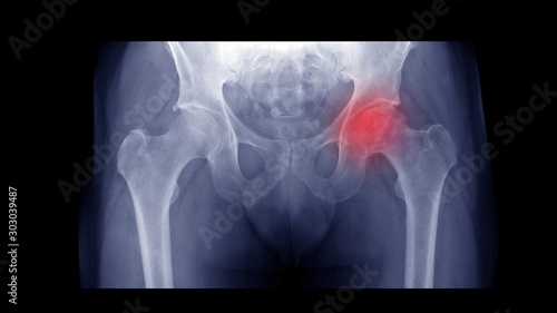 Film X-ray hip radiograph show Left femoral head collapse form Avascular necrosis (AVN) or Osteonecrosis (ON) disease. Right hip show osteoarthritis  joint disorder(OA). Medical technology concept. photo