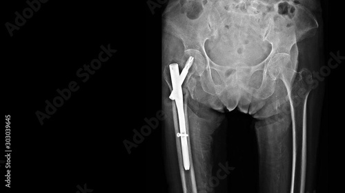 фотографія Film X ray hip show thigh bone broken(intertrochanteric femur fracture) treated by surgery with cephalomedulary nail implant(Proximal femoral nail antirotation or PFNA)