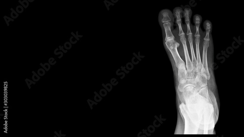 Quadro em tela Film foot X ray radiograph show toe bone broken ( base of metatarsal fracture or Jones fracture ) from fall from ladder