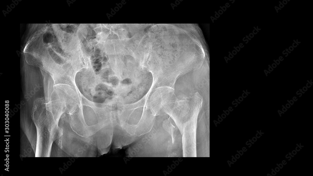 Film X ray hip radiograph show broken hip bone (intertrochanteric ...