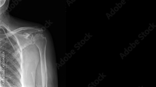 Film X ray shoulder show Hill-Sachs lesion. Hill Sachs lesion is posterolateral humeral head compression fracture from impaction on glenoid rim after shoulder is dislocated. Medical imaging concept photo