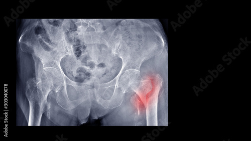 Film X-ray hip radiograph show broken hip bone (intertrochanteric fracture of femur). Elderly patient has osteoporosis and accidental fall at home. nursing care and fall prevention concept.