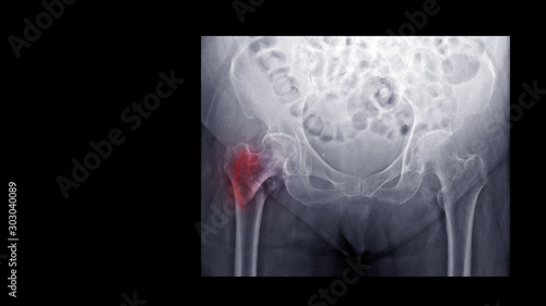 Film X-ray hip radiograph show broken hip bone (intertrochanteric fracture of femur)l. Elderly patient has osteoporosis and traumatic injury at home. nursing care and fall prevention concept.