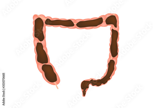 Constipation in intestine / colon vector / stomach