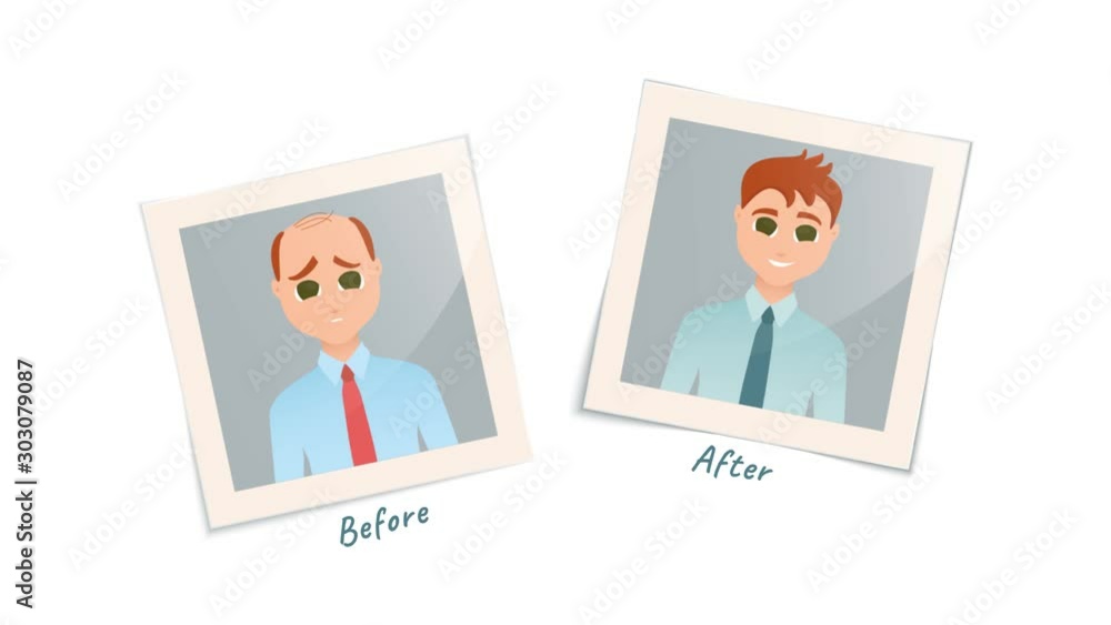 Animation of photographs of a man before and after hair treatment Animation of photographs of a man before and after hair treatment