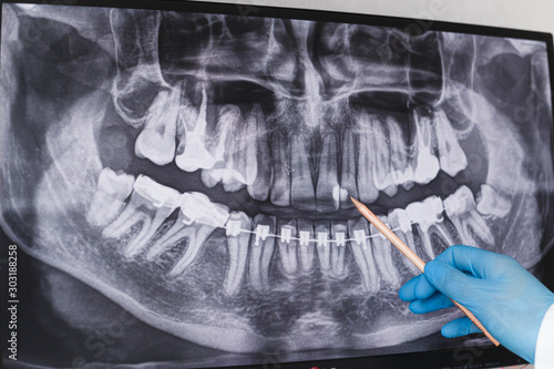 Doctor points to cured filled tooth in dental x-ray