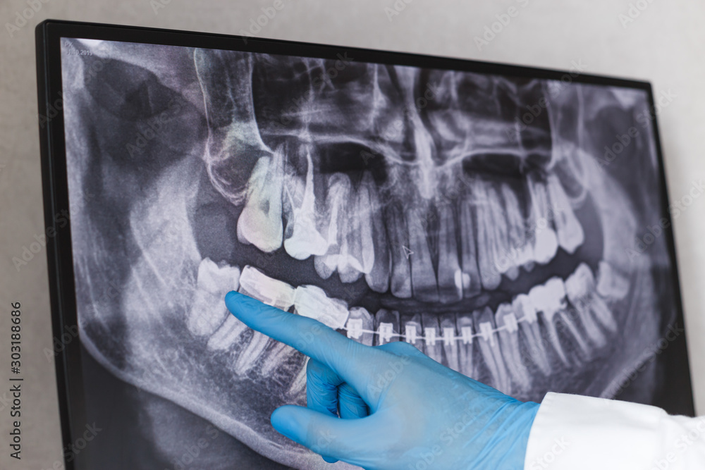 Doctor points wisdom tooth in dental x-ray