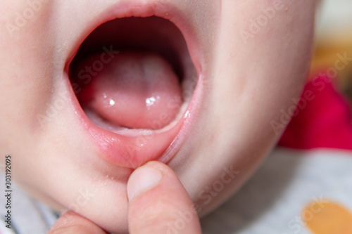 Tableau sur toile baby's first tooth,the infant shows the first tooth that grows