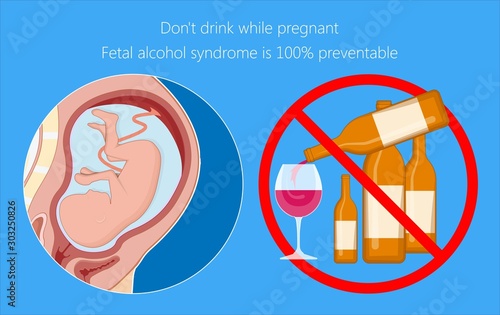 Fetal alcohol spectrum syndrome disorders conditions mother drank during pregnancy cause brain damage and birth defect in children