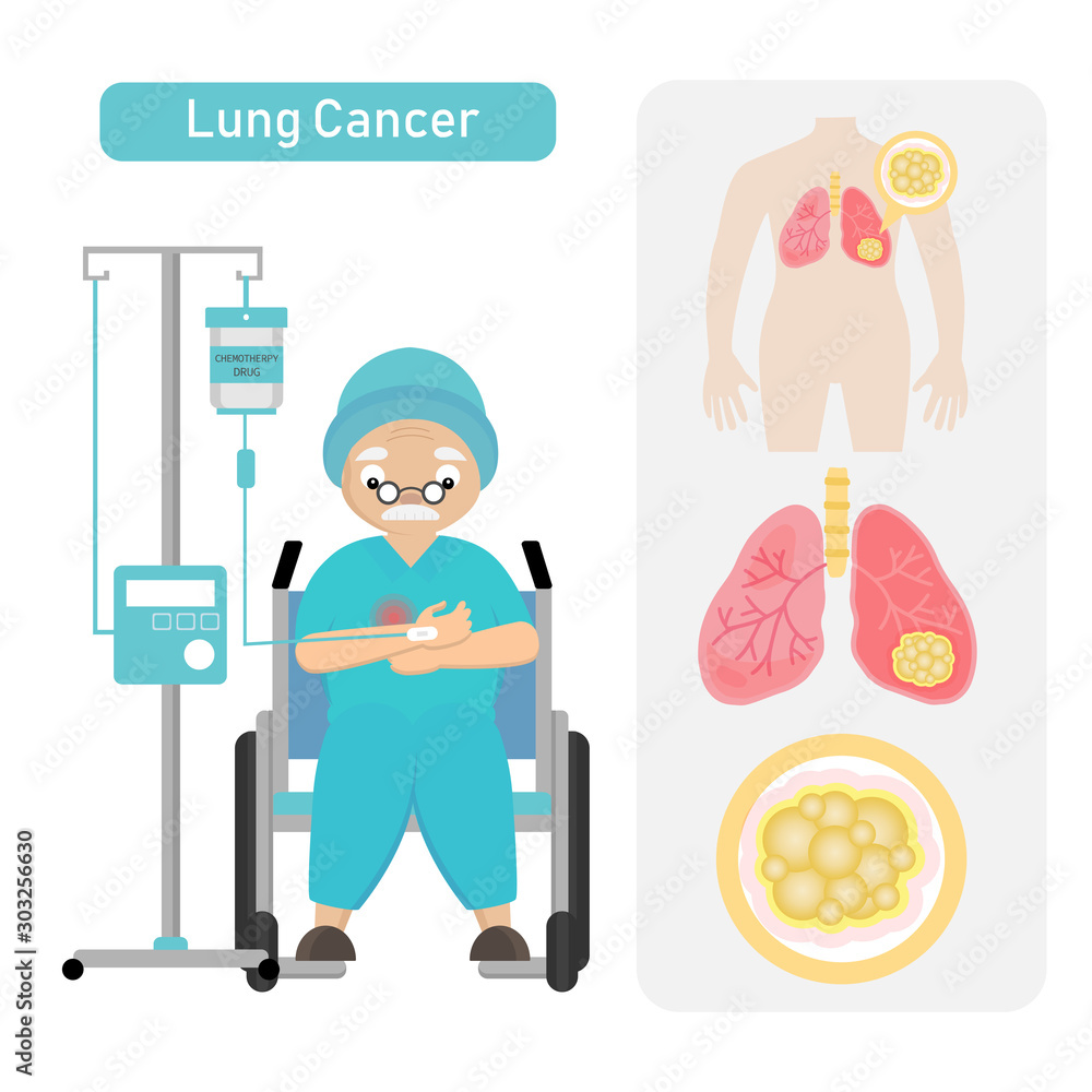 Fototapeta premium Senior Patient with Lung Cancer in cartoon style.