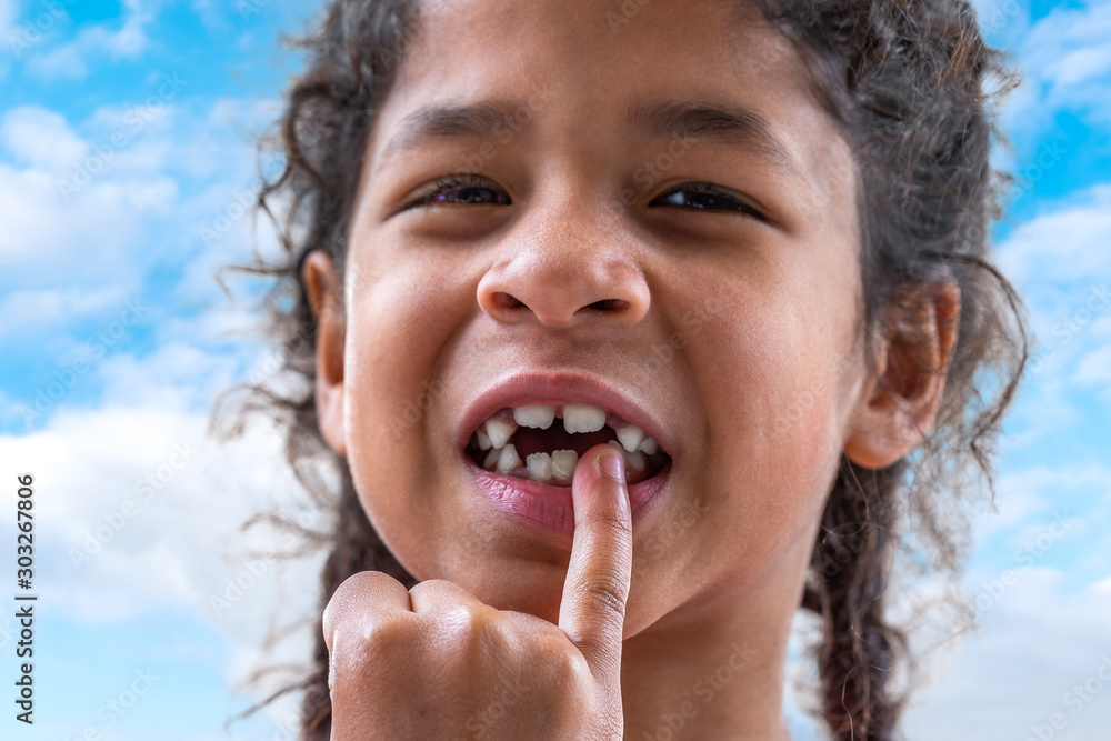 close up girl mouth with crooked broken teeth and odontolith, will need a dental appliance close up girl mouth with crooked broken teeth and odontolith, will need a dental appliance