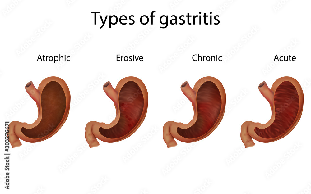 Types of gastritis. Atrophic, acute, chronic, erosive. Abdominal ...