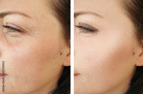 woman face wrinkles before and after treatment photo