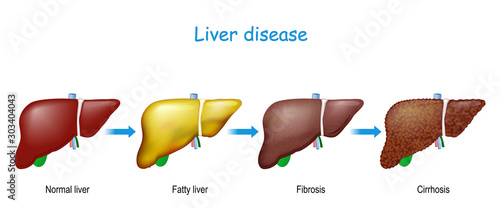 Liver disease. From healthy internal organ to Fatty liver, fibrosis, and Cirrhosis.