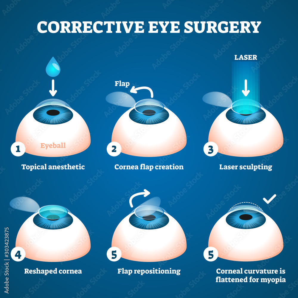 Foto Corrective eye surgery vector illustration
