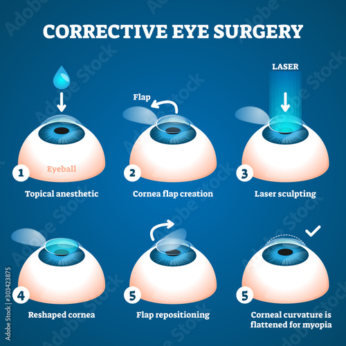 Corrective eye surgery vector illustration. Laser process education scheme.