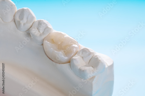 Closeup / Prosthodontics or Prosthetic / Single teeth crown and bridge equipment model express fix restoration.