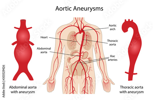 Aortic aneurysms: Thoracic and Abdominal. Arterial circulatory system of the abdominal. Abdominal aorta and thoracic aorta with aneurysm. Vector illustration in flat style isolated on white background photo