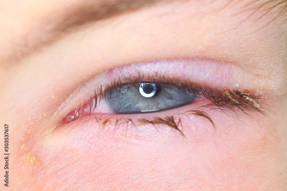 Obraz premium Conjunctivitis is a viral bacterial infection in the eye of a boy.