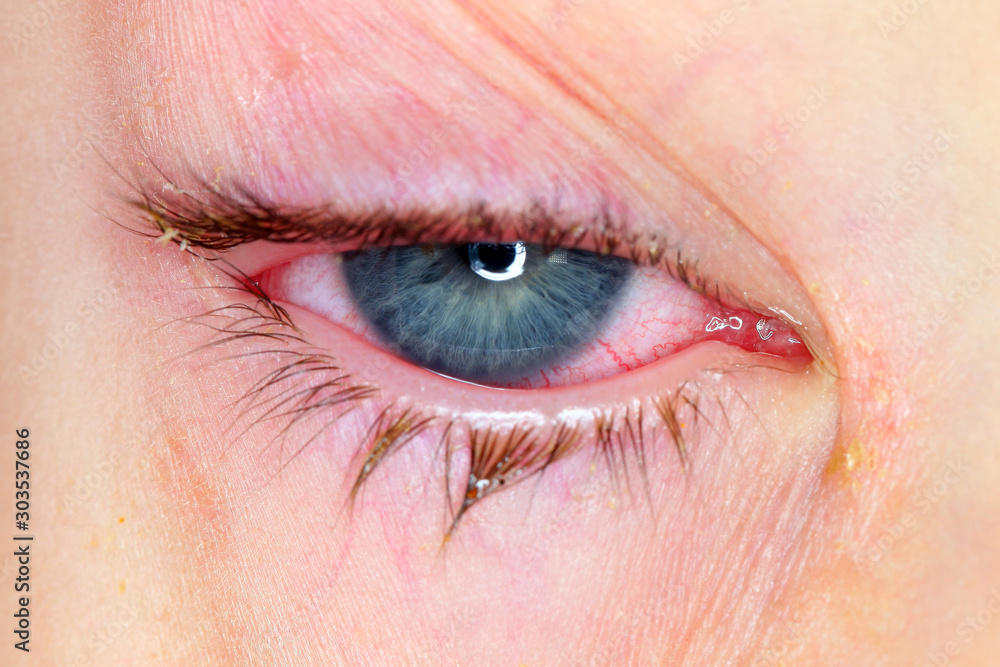 Φωτογραφία Conjunctivitis is a viral bacterial infection in the eye of a boy