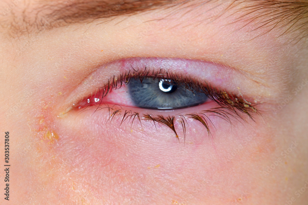 Φωτογραφία Conjunctivitis is a viral bacterial infection in the eye of a boy