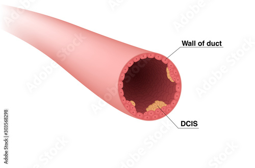 Lactiferous duct and ductal carcinoma. DCIS. Vector illustration showing cross section of milk duct with cancer cells.