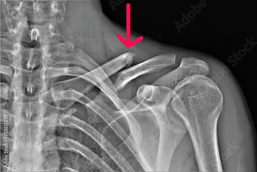 Foto radiography of the shoulder joint and ribs in direct projection with a fracture