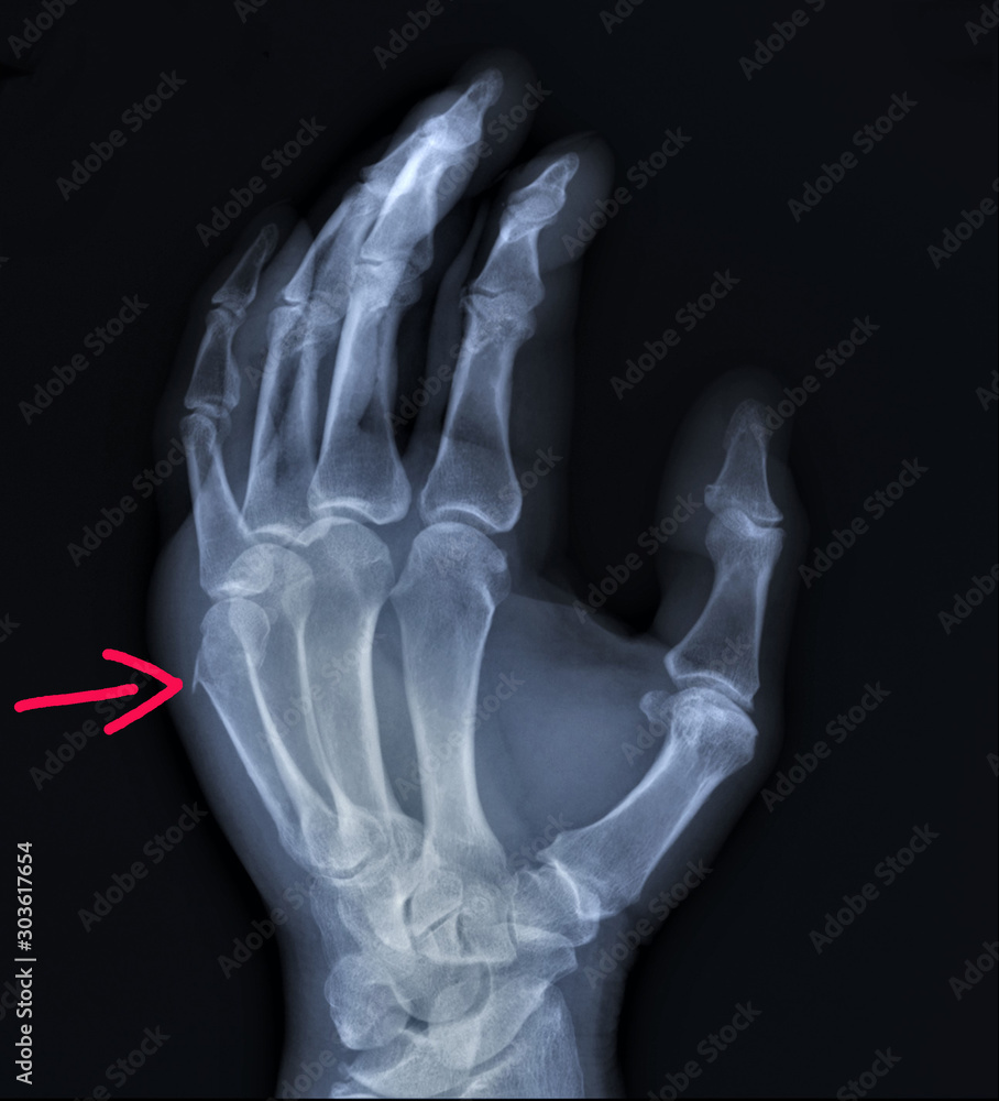 on the x-ray of the hand fracture of the metacarpal bone, traumatology, medical diagnosis on the x-ray of the hand fracture of the metacarpal bone, traumatology, medical diagnosis