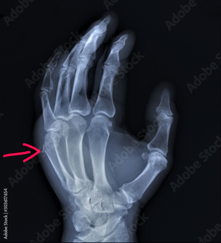on the x-ray of the hand fracture of the metacarpal bone, traumatology, medical diagnosis