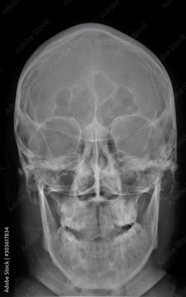 normal x-ray of the skull in direct projection, medical diagnostics, traumatology and orthopedics, neurosurgery normal x-ray of the skull in direct projection, medical diagnostics, traumatology and orthopedics, neurosurgery