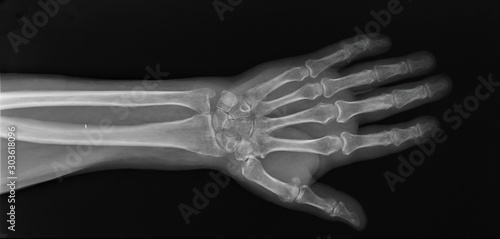 normal radiography of hand and wrist bones, traumatology and orthopedics, traumatology
