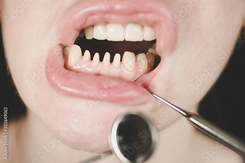 Dentistry and orthopedic treatment concept. Human teeth requiring prosthetics. Close-up. Soft focus.