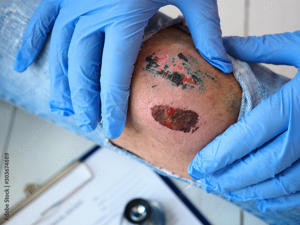 Φωτογραφία The doctor examines the healing wound of the patient on the leg of the knee torn