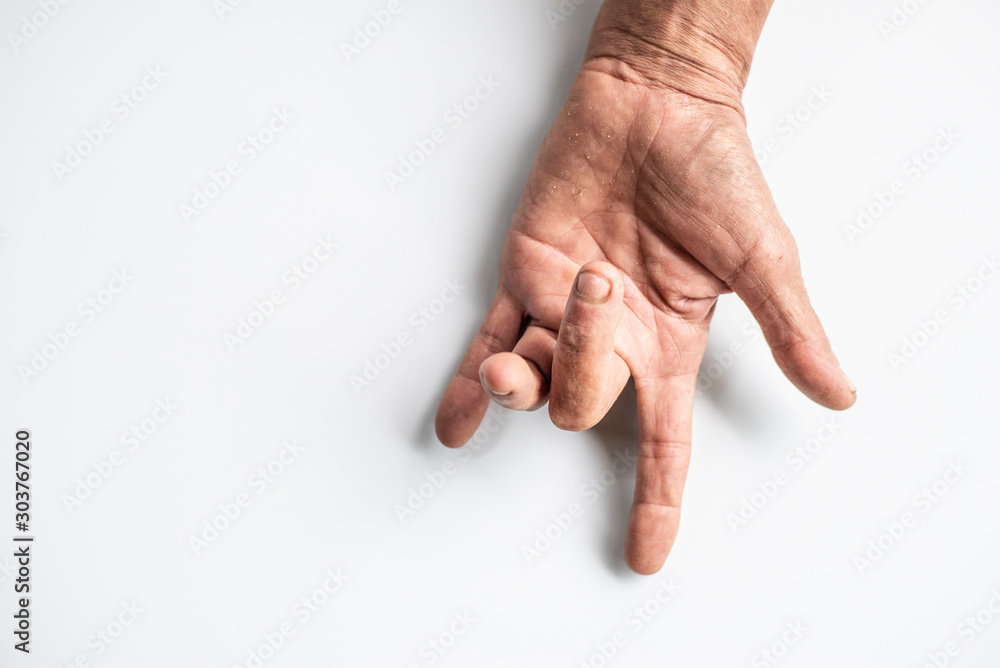 Obraz premium Trigger Finger a defect in a tendon causing a finger to jerk or snap straight when the hand is extended.